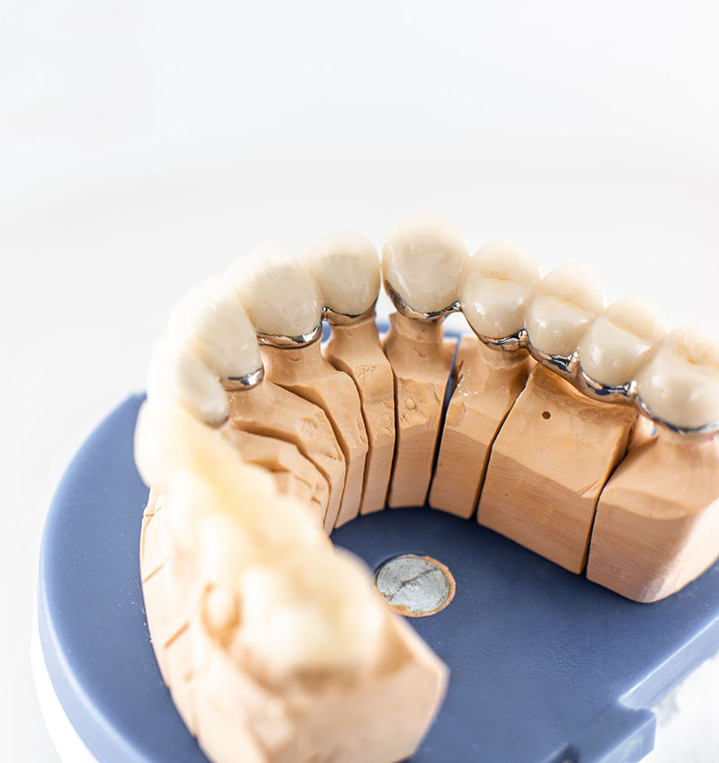 Skillfully Crafted Dental Crowns